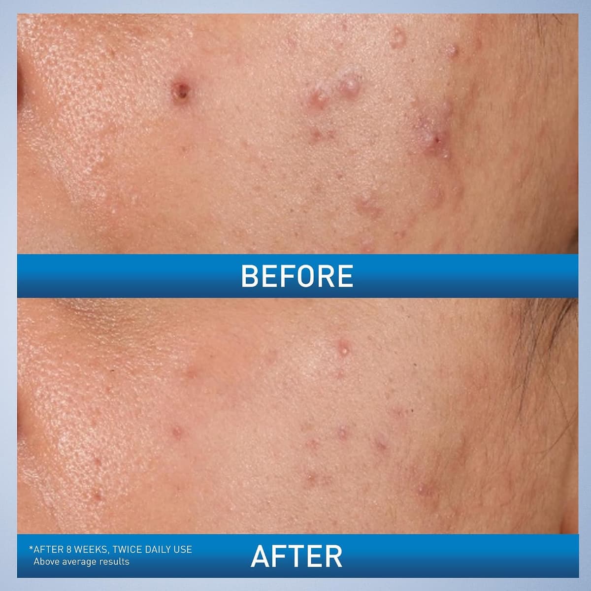 Cerave Acne Control Gel