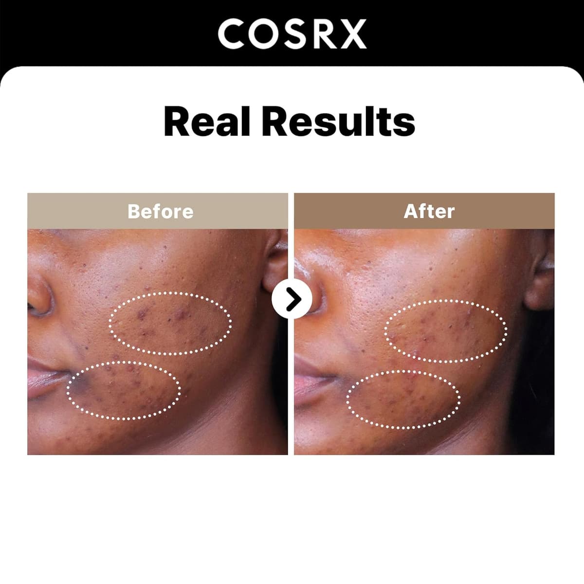 Cosrx The Alpha Arbutin 2 Discoloration Care Serum