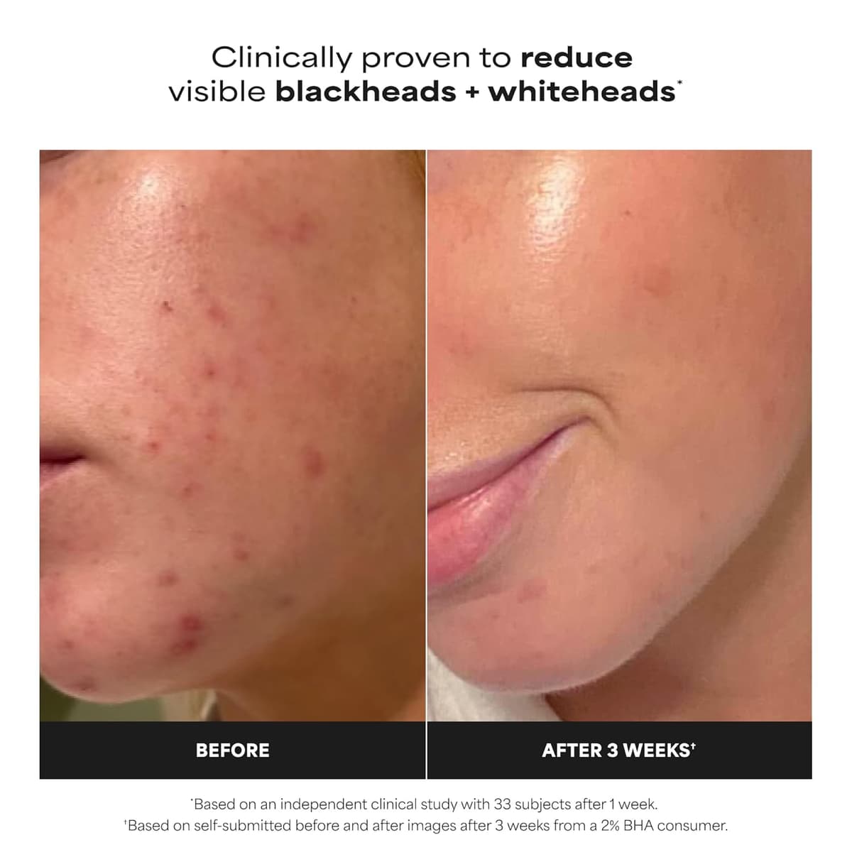 PAULA’S CHOICE SKIN PERFECTING 2% BHA LIQUID EXFOLIANT