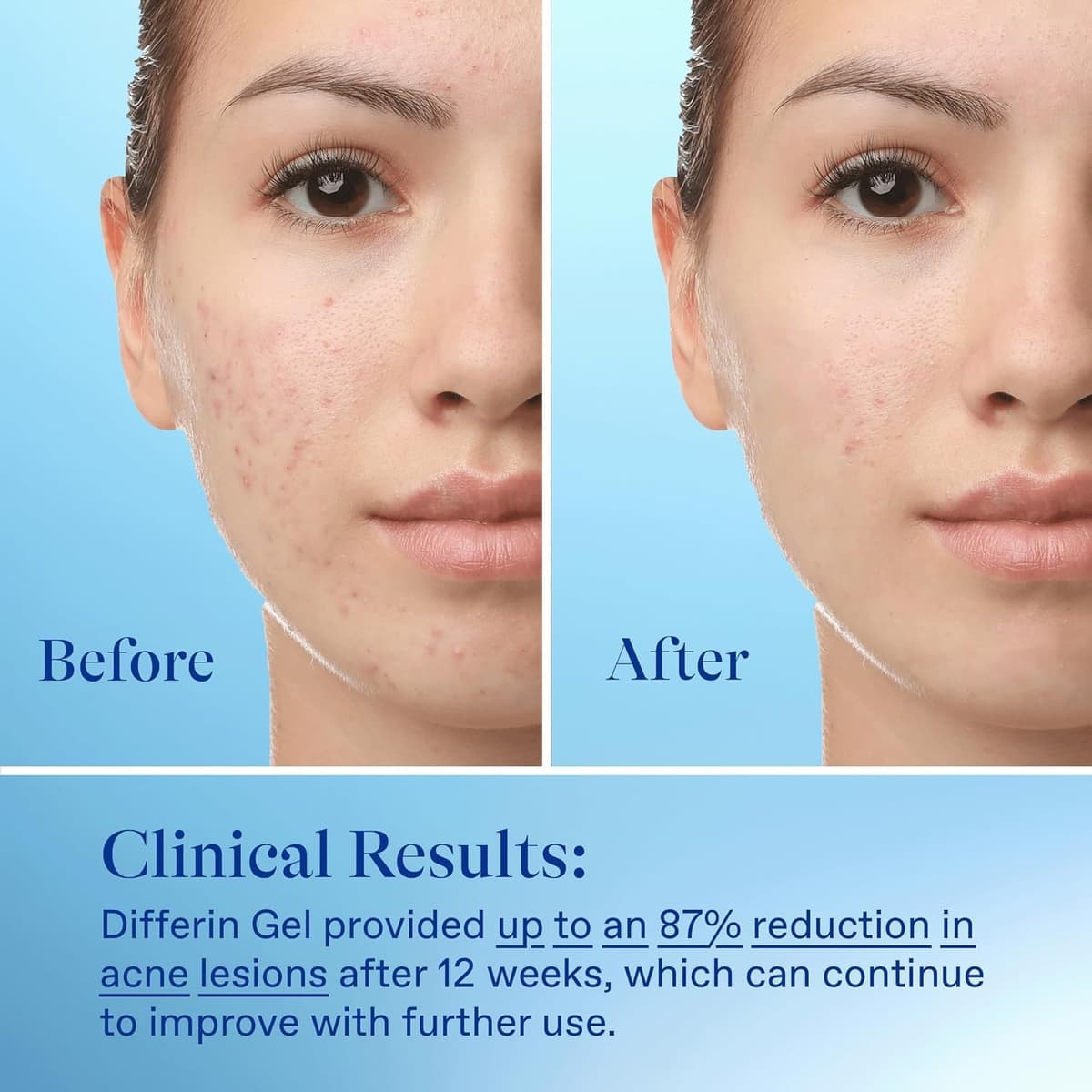 Differin Acne Treatment Gel
